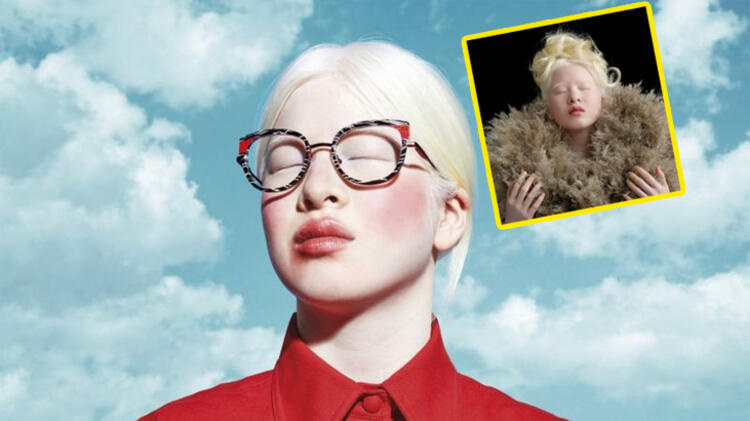 albinizmli-olduguna-gore-terk-edildi-indi-dunya-taniyir