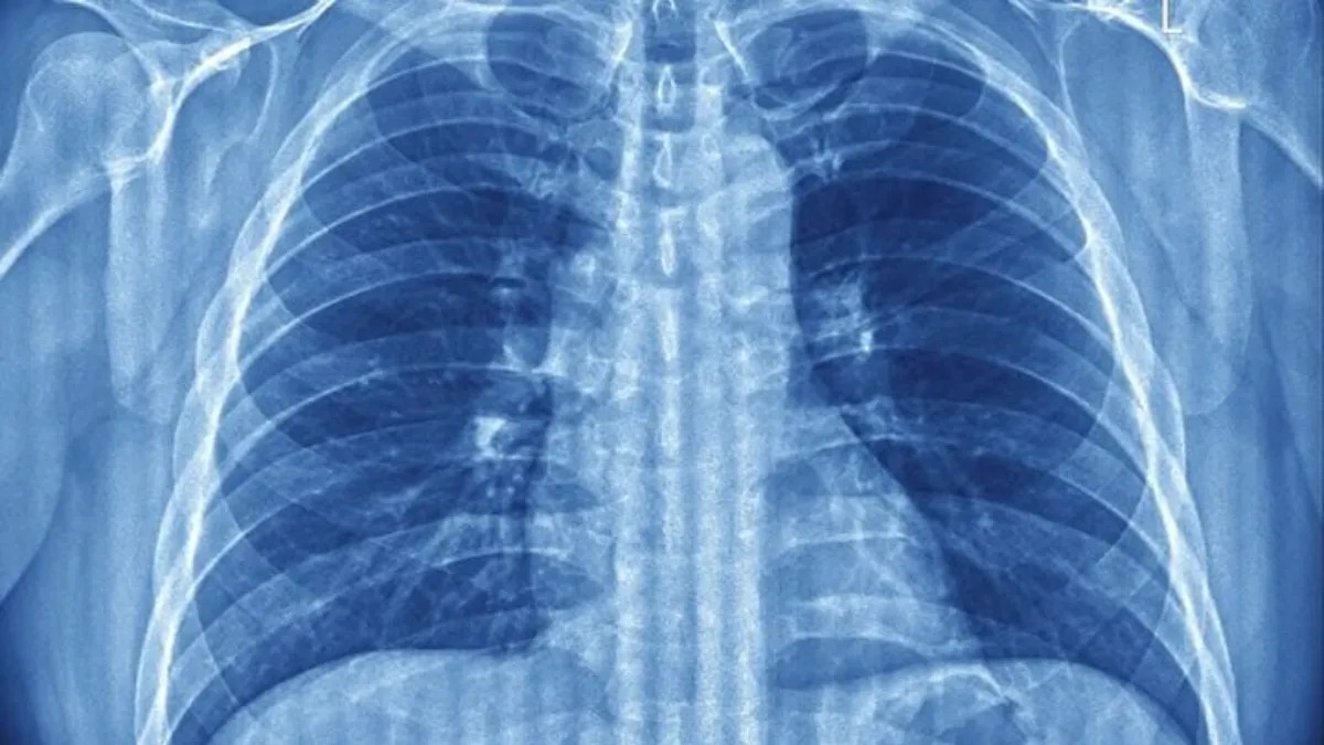 ah-cekmek-agciyerlerin-cokmesinin-qarsisini-alir