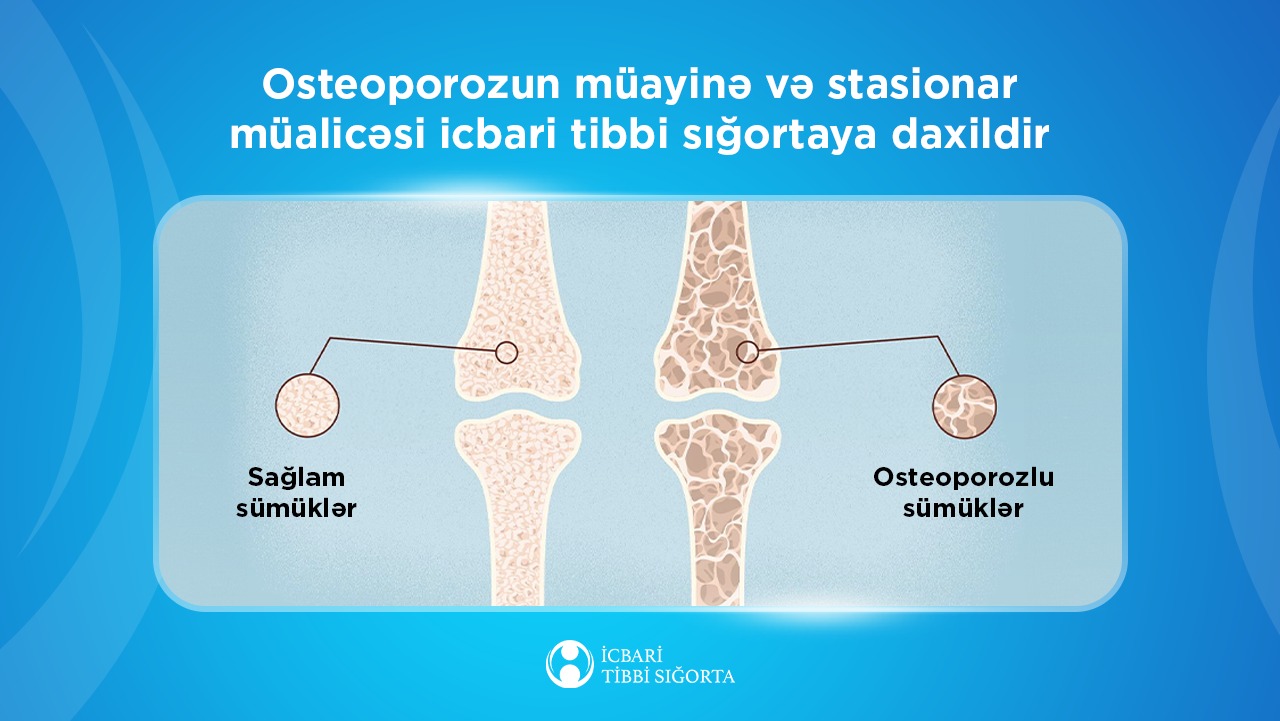 bu-sumuk-xesteliyinin-mualicesi-icbari-tibbi-sigortaya-daxil-edildi